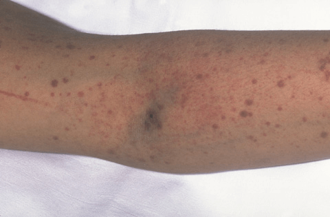 The photograph shows two types of bruising that are often seen with TTP. The larger red, brown, and purple dots are purpura, and the smaller red and purple dots are petechiae.