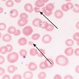 internal-ttp-signs A blood film from a patient with TTP showing relatively minor changes. Platelets are severely reduced and there are occasional red cell fragments (arrowed)